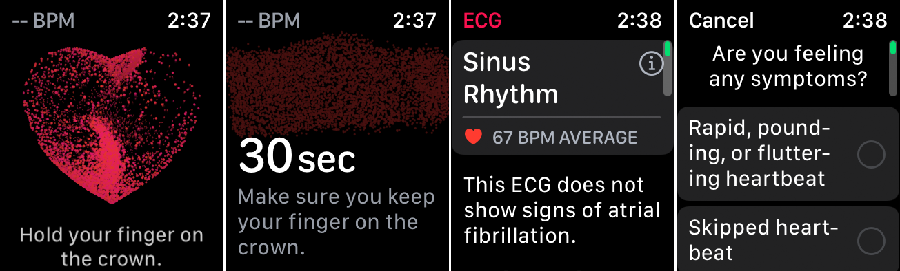 EKG