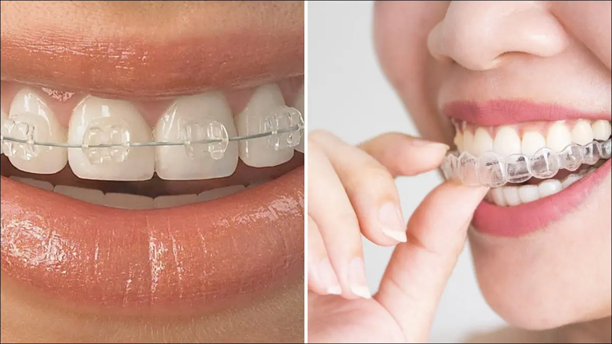 Dos tipos de brackets cerámicos transparentes.